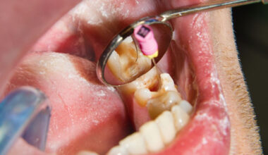 Endodontic Surgery and the Recovery Process