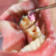 Endodontic Surgery and the Recovery Process