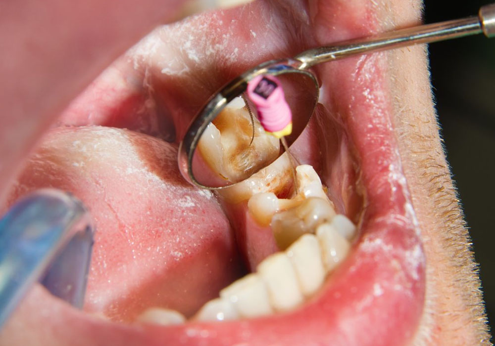 Endodontic Surgery and the Recovery Process