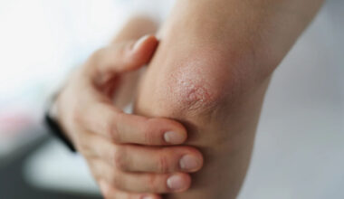 How to Recognize the Early Warning Signs of an Autoimmune Disease