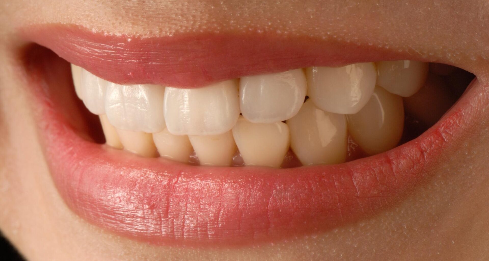 The Functional Side Of Porcelain Veneers