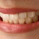The Functional Side Of Porcelain Veneers